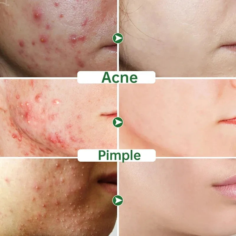 Crema Facial Acnes