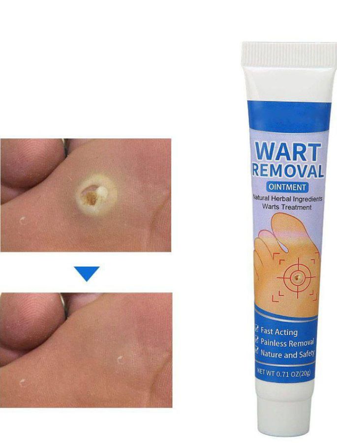 Crema para Eliminar Verrugas de la Piel