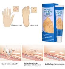 Crema para Eliminar Verrugas de la Piel